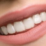 arc teeth whitening